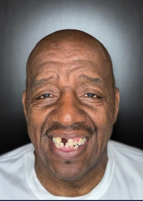 Before: the original smile with missing and worn teeth