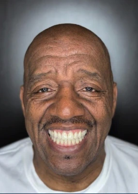 After: the same person’s bright illustrative smile simulation