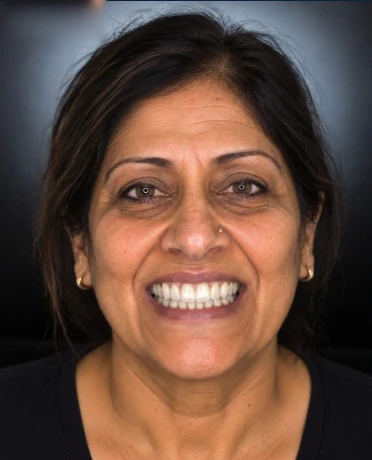 After: the same person’s illustrative bright smile simulation